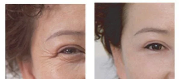 果酸换肤去眼角细纹多少钱？