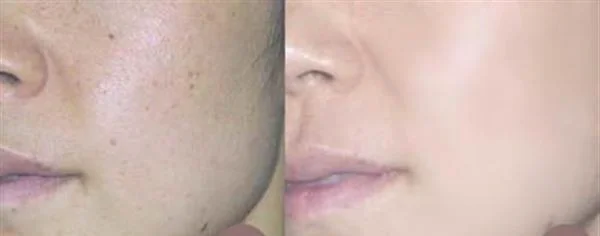 做激光祛晒斑治疗效果怎么样？效果保持时间多久？