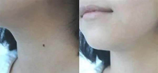 做激光点黑痣手术多少钱？