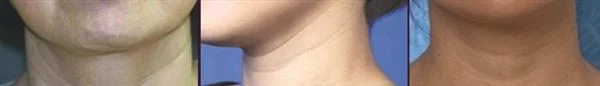 做去颈纹失败修复手术多少钱？