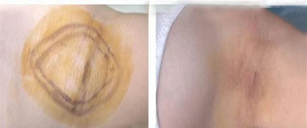 激光去腋臭手术安全吗？