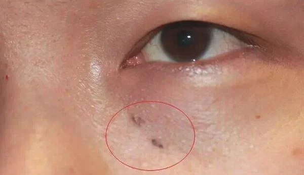做去黑痣价格要多少
