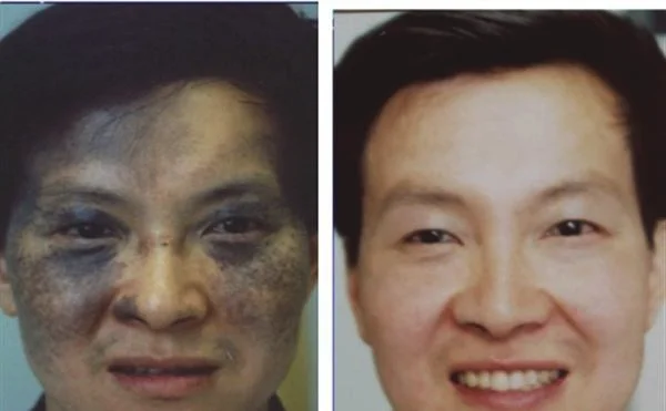 做去胎记治疗效果怎么样？效果保持时间多久？