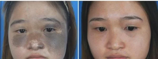 做光子治疗太田痣治疗效果怎么样?效果保持时间多久?