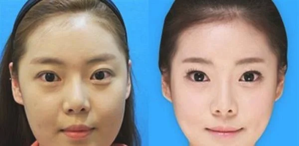 硅胶植入去法令纹手术效果好不好？