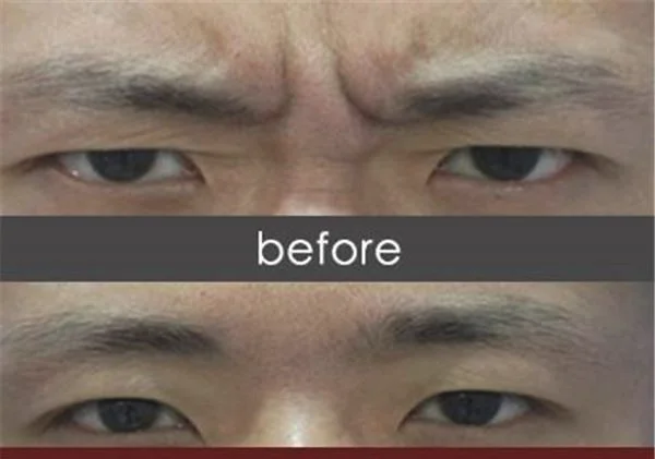 微晶磨皮去眉间纹维持时间是多久？