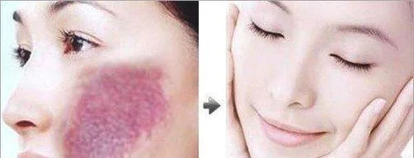 做去胎记手术多少钱?