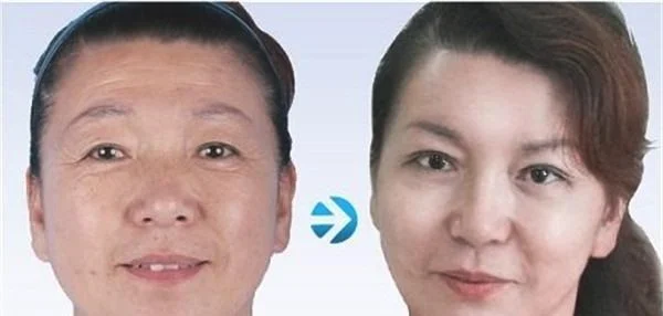 做玻尿酸去抬头纹价格