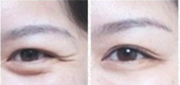 做去鱼尾纹失败修复价格