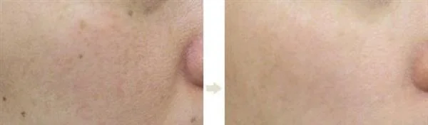 光子去黑痣手术安全吗？