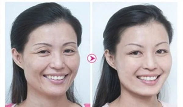 微晶磨皮去鱼尾纹优点是什么？