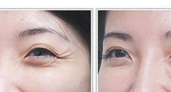 做射频微针去眼角细纹手术注意事项是什么？