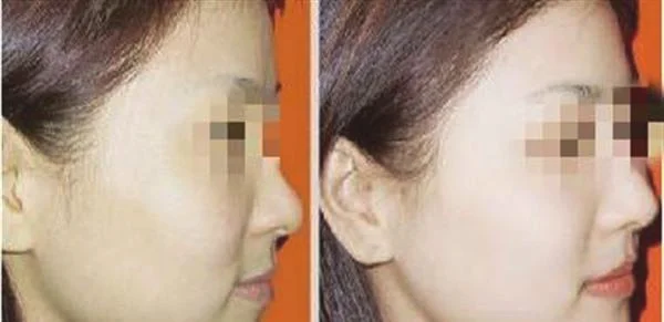 黑脸娃娃美白手术安全吗？