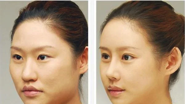 做彩光嫩肤治疗效果怎么样?效果保持时间多久?