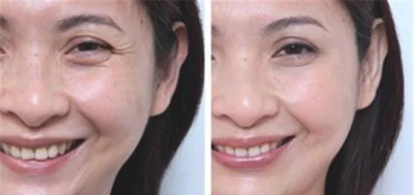玻尿酸去鱼尾纹效果怎么样？