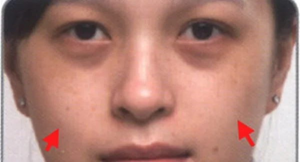 做玻尿酸去痘疤手术注意事项是什么？
