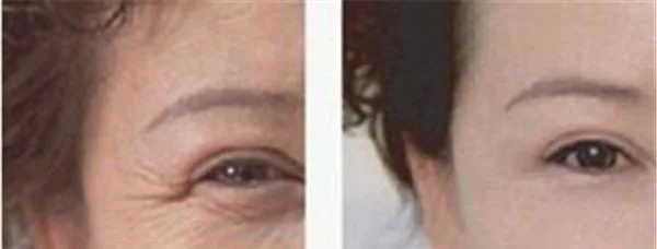 射频微针去眼角细纹效果如何？
