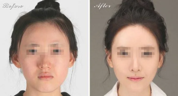 做胶原蛋白填充去痘疤治疗效果怎么样？效果保持时间多久？