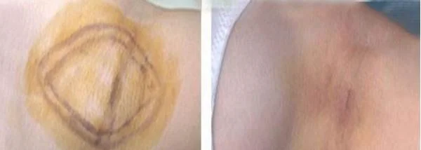 做激光去腋臭治疗效果怎么样?效果保持时间多久?