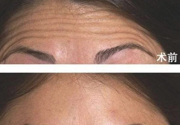 做爱贝芙去除抬头纹手术多少钱?