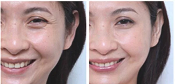 射频去鱼尾纹要多少钱？