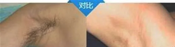 做冷冻去狐臭多少钱