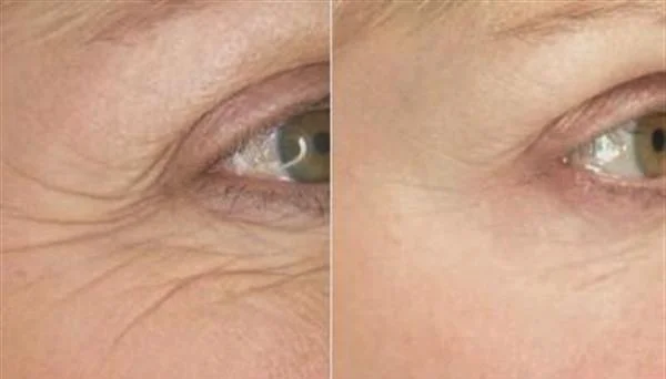 做去鱼尾纹多少钱