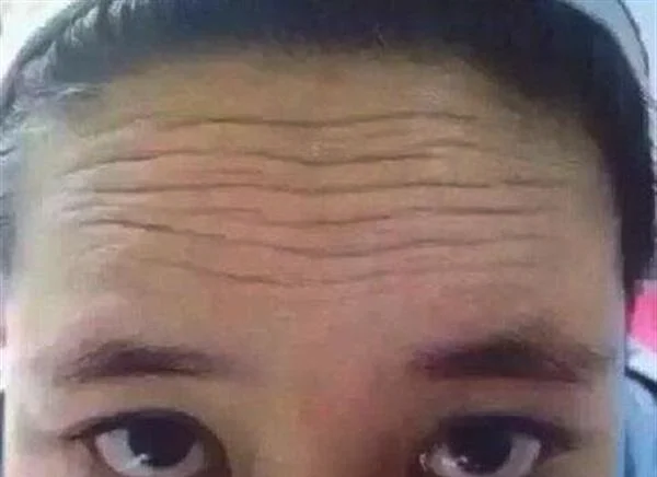 玻尿酸去抬头纹要多少钱？