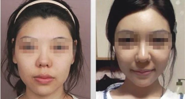 自体脂肪去眼角细纹手术术后护理？