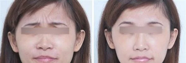 脉冲光去眉间纹效果怎么样？