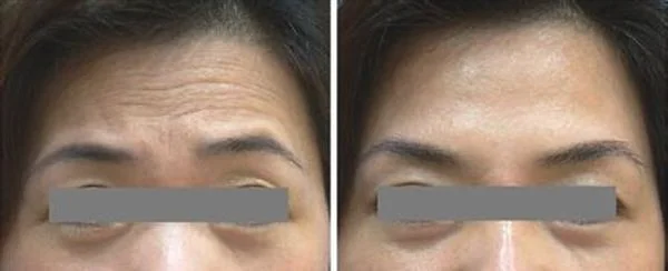 玻尿酸去抬头纹手术注意事项是什么？