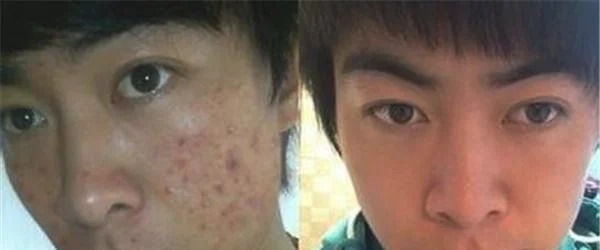 针清祛痘优点有哪些？