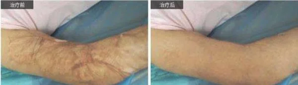 烧伤疤痕修复手术安全吗？