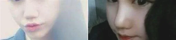 硅胶植入去法令纹手术术后护理？