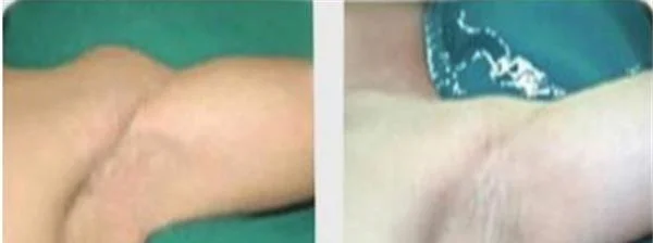 做切除法去腋臭价格多少钱
