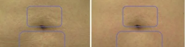 做光子去妊娠纹治疗效果怎么样？效果保持时间多久？