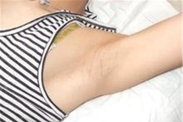 做冷冻法去腋臭价格