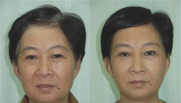 做E光去法令纹价格