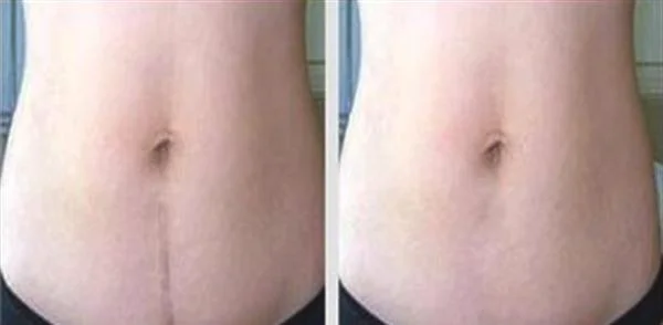 剖腹产疤痕修复有哪些优点?