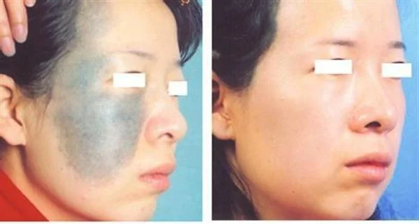 去胎记手术效果好不好？