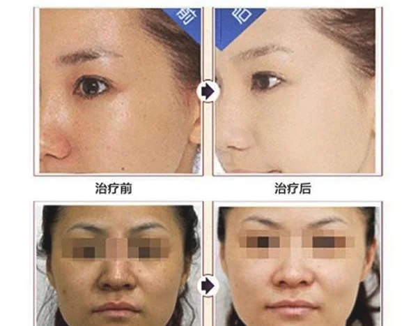 激光美白效果怎么样?