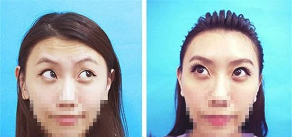 光子除抬头纹优点是什么？