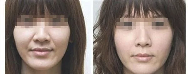 爱贝芙去法令纹效果怎么样？