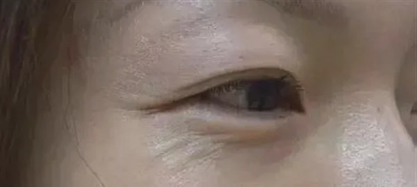 去眼角细纹失败修复有什么注意事项？