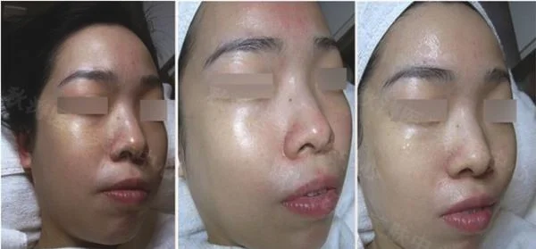 做黑脸娃娃去痘印治疗效果怎么样?效果保持时间多久?