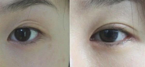 做眼睑疤痕修复价格要多少