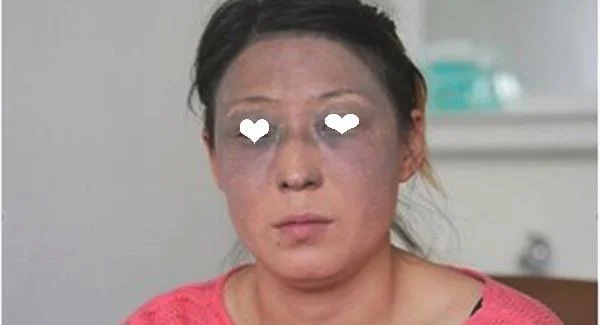 做微晶治疗太田痣手术注意事项是什么？