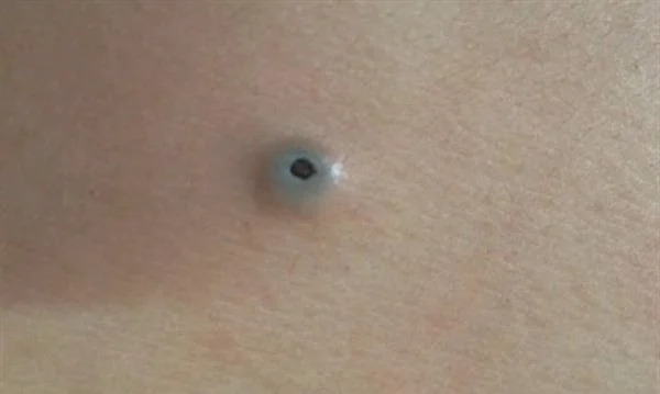 去黑痣手术术后护理?