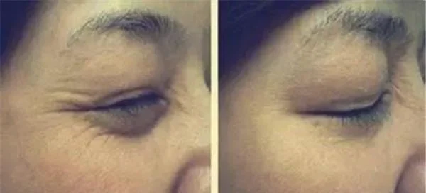 做脉冲光去眼角细纹价格