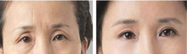 自体脂肪去眉间纹维持时间是多久?